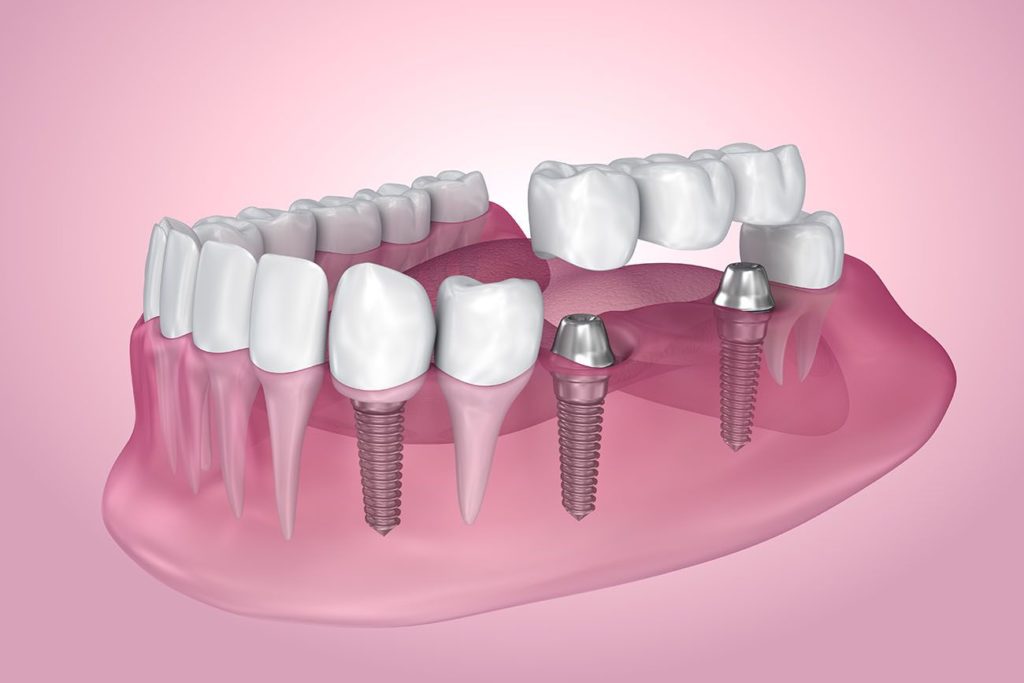 types of dental implants in Clinton North Carolina