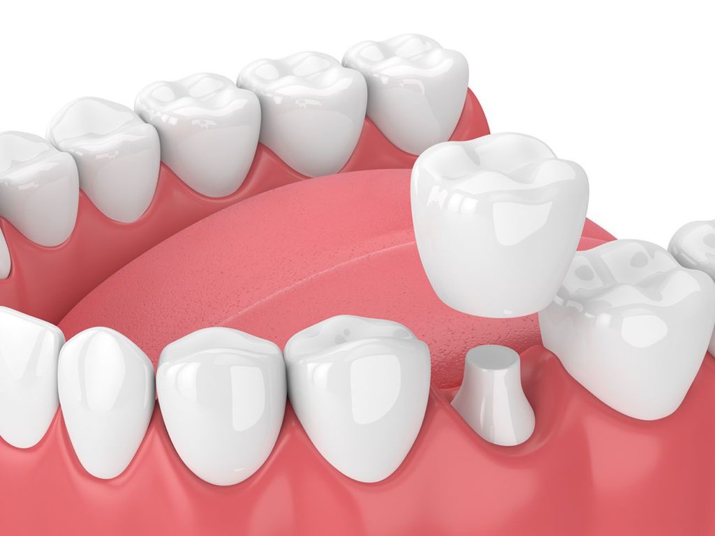 dental crown benefits in Clinton North Carolina