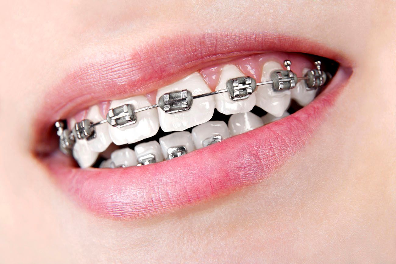 braces and other cosmetic dental work options