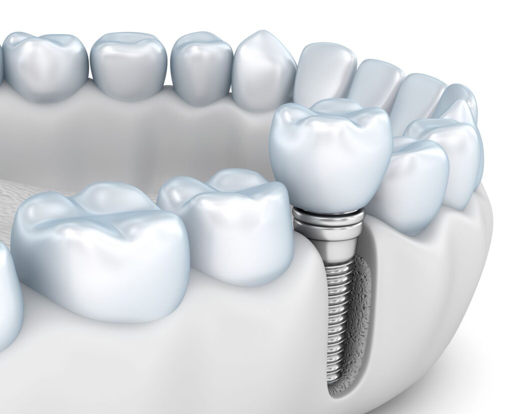 Jawbone Health and Implant Dentistry