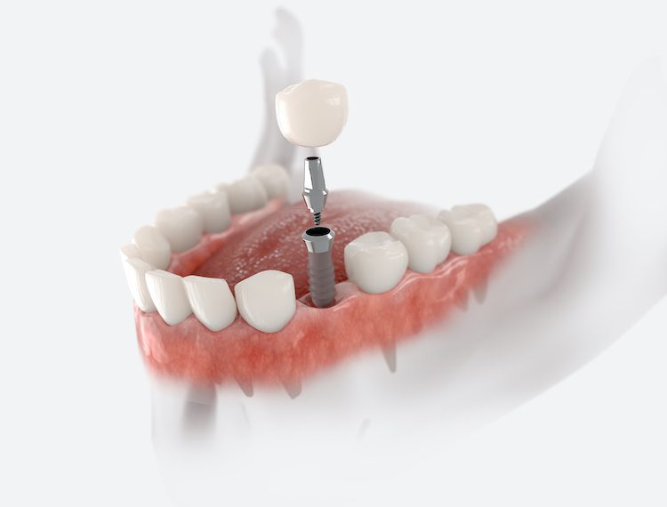 Understanding the dental implant process can alleviate anxiety and set realistic expectations for your treatment.