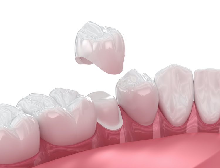 Understanding the process for getting a dental crown can help ease any anxiety and ensure a smoother recovery.